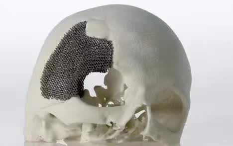 顱骨3D打印技術(shù)是什么？